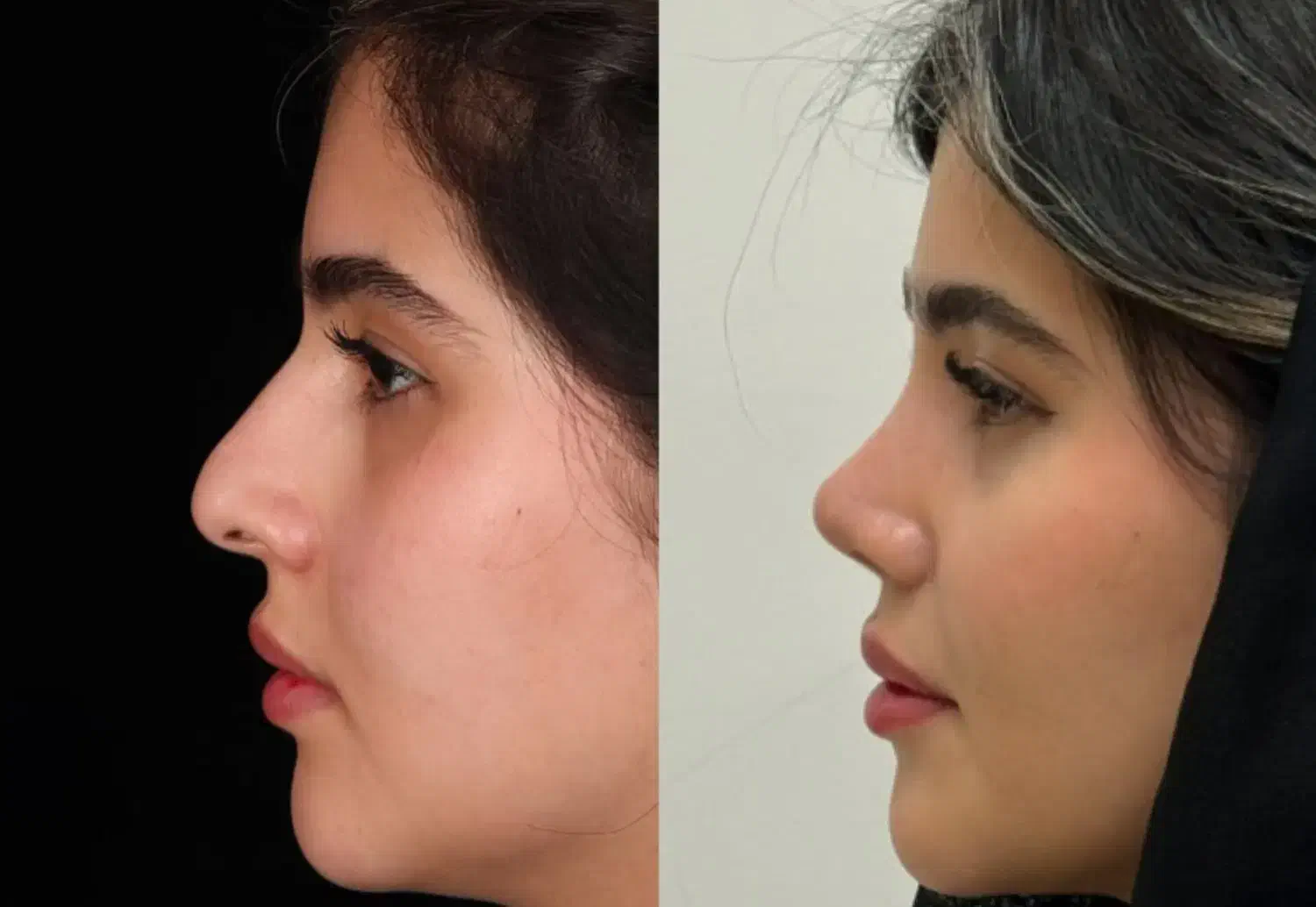 عمل جراحی بینی پیزوسرجری با بهترین کیفیت و قیمت|خدمات آرایشگری و زیبایی|رفسنجان, |دیوار