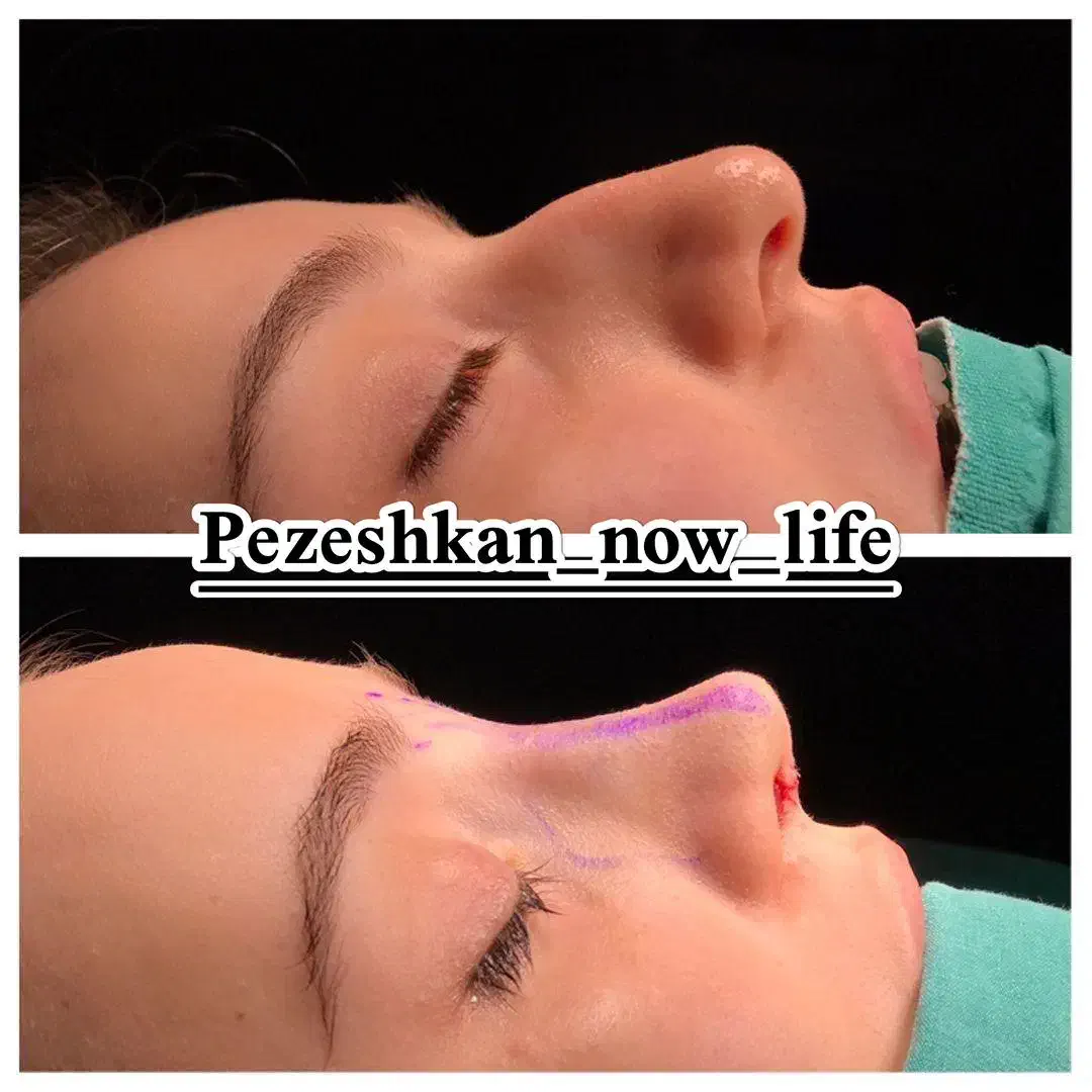 جشنواره عمل بینی فقط (۳۵) توسط متخصص|خدمات آرایشگری و زیبایی|شاهین‌شهر, فردوسی|دیوار