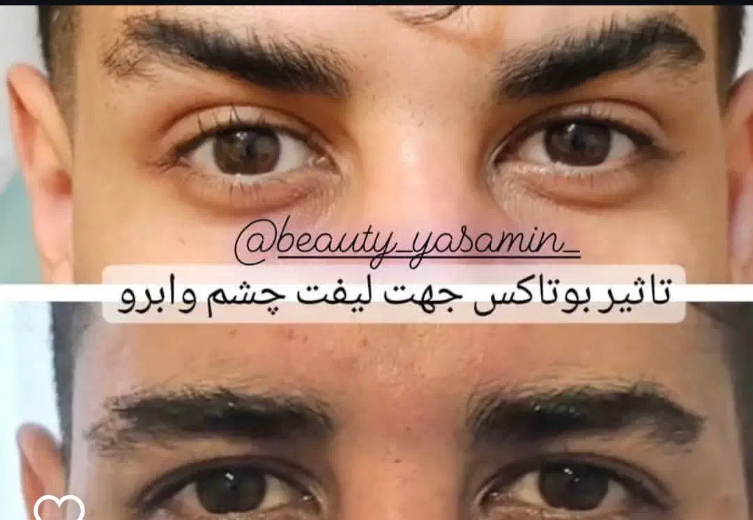 خدمات تخصصی تزریق بوتاکس فیلر بانوان و آقایون|خدمات آرایشگری و زیبایی|بیرجند, |دیوار