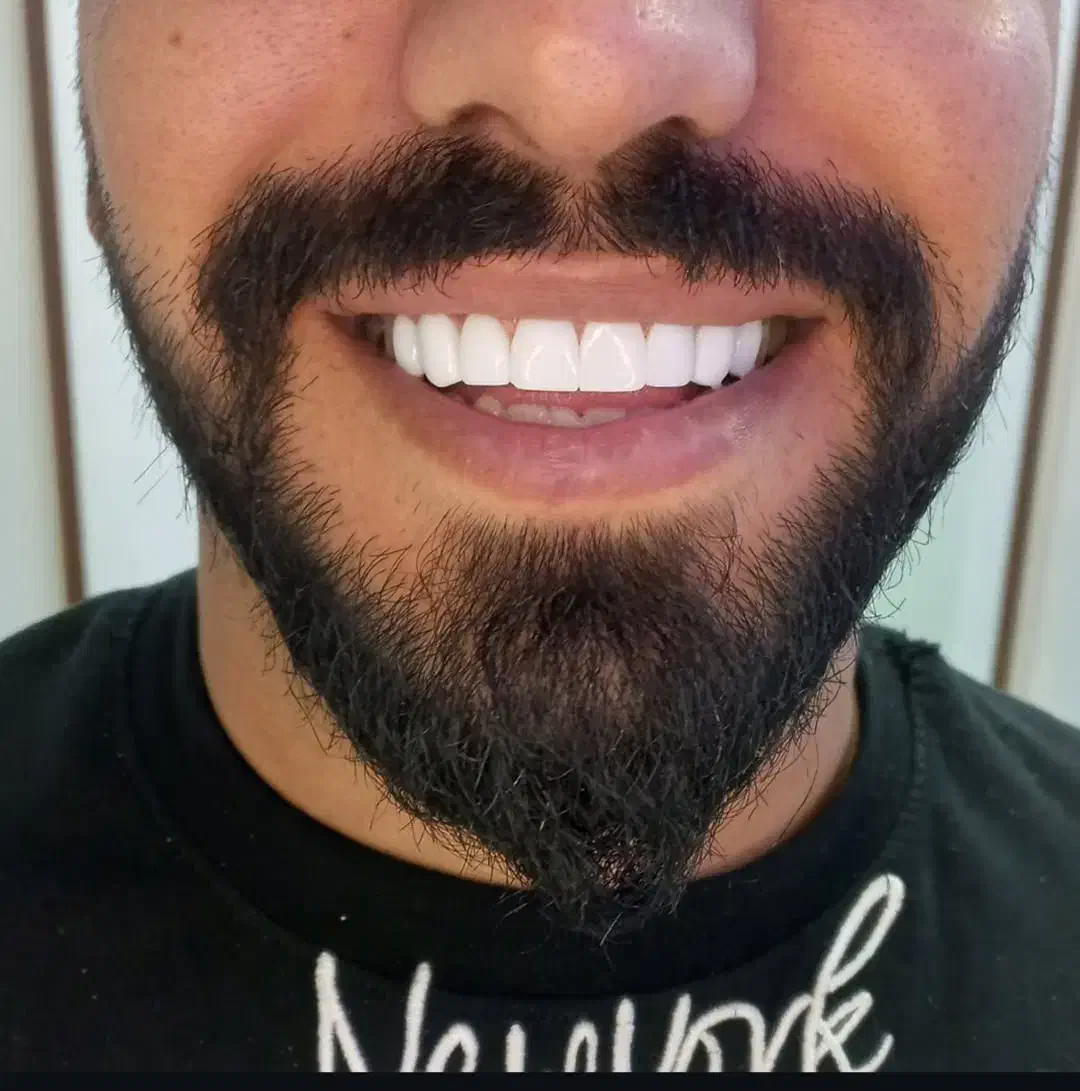 زیبایی،کامپوزیت دندان،عصب کشی(یاسوج)|خدمات آرایشگری و زیبایی|دوگنبدان, |دیوار