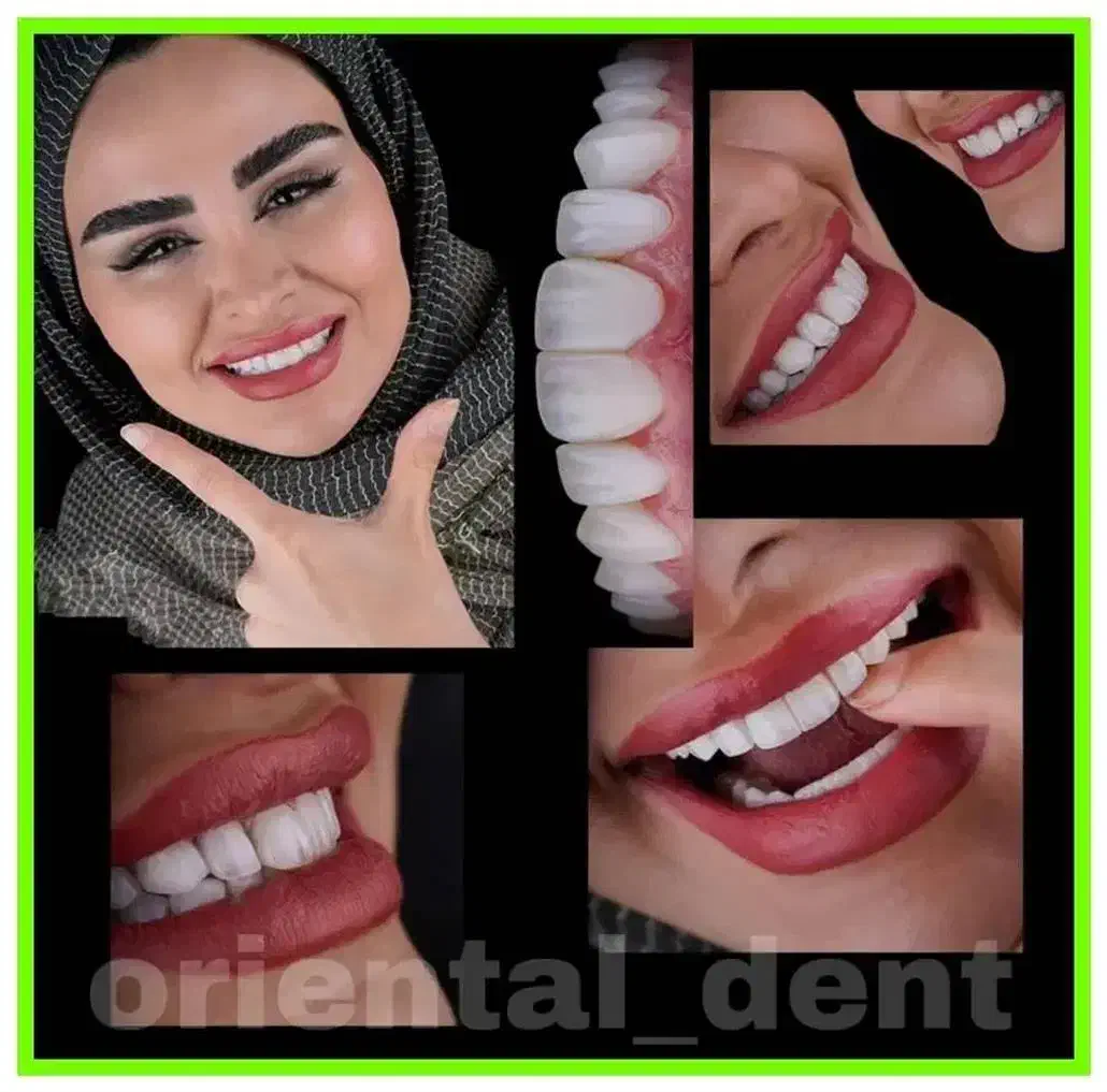 قسطی ایمپلنت و تمام خدمات دندانپزشکی بدون پیش|خدمات آرایشگری و زیبایی|اصفهان, دشتستان|دیوار