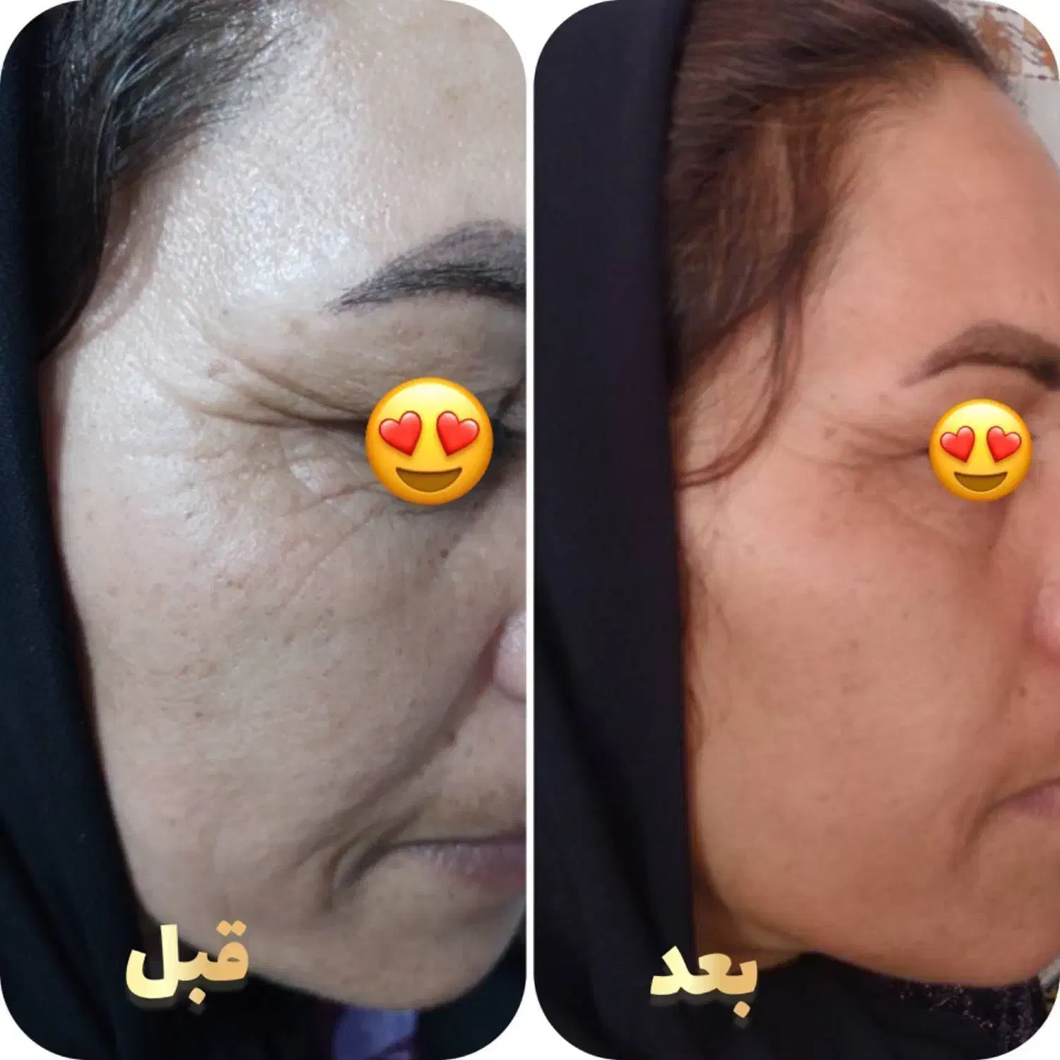 چین چروک تکسوو|آرایشی، بهداشتی، درمانی|شیراز, شاهچراغ|دیوار