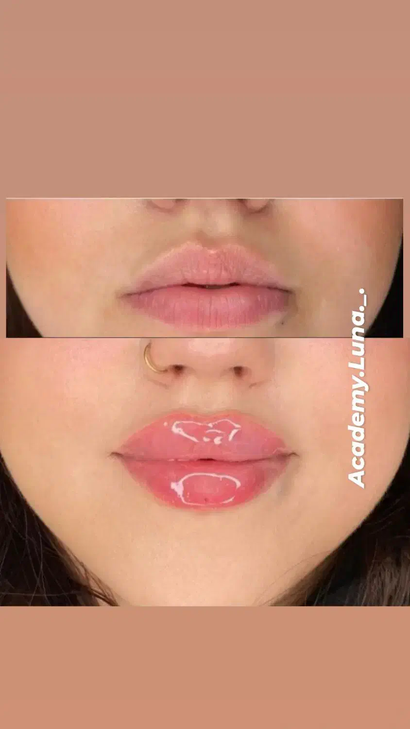 بوتاکس رایگان|خدمات آرایشگری و زیبایی|قم, زنبیل آباد|دیوار