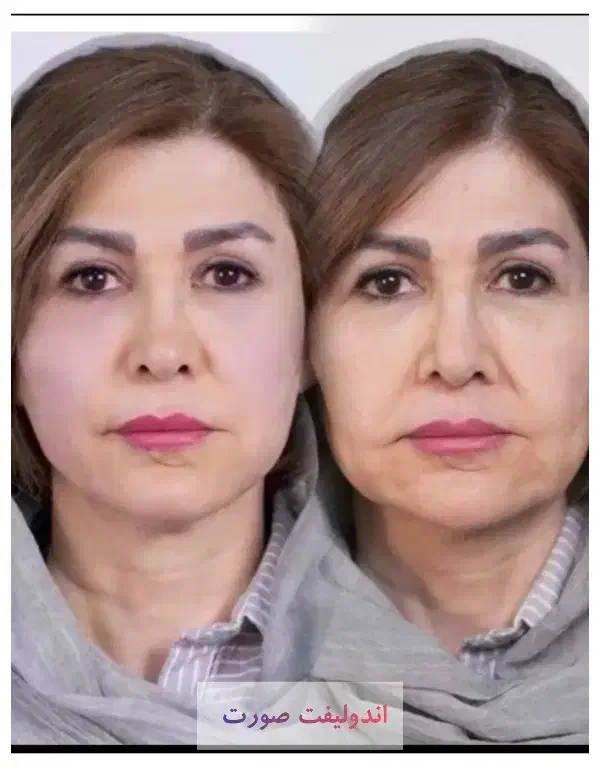 لیزر تاتو وخالکوبی ،جای جوش بخیه زخم،اندولیفت|خدمات آرایشگری و زیبایی|فولادشهر, B5|دیوار