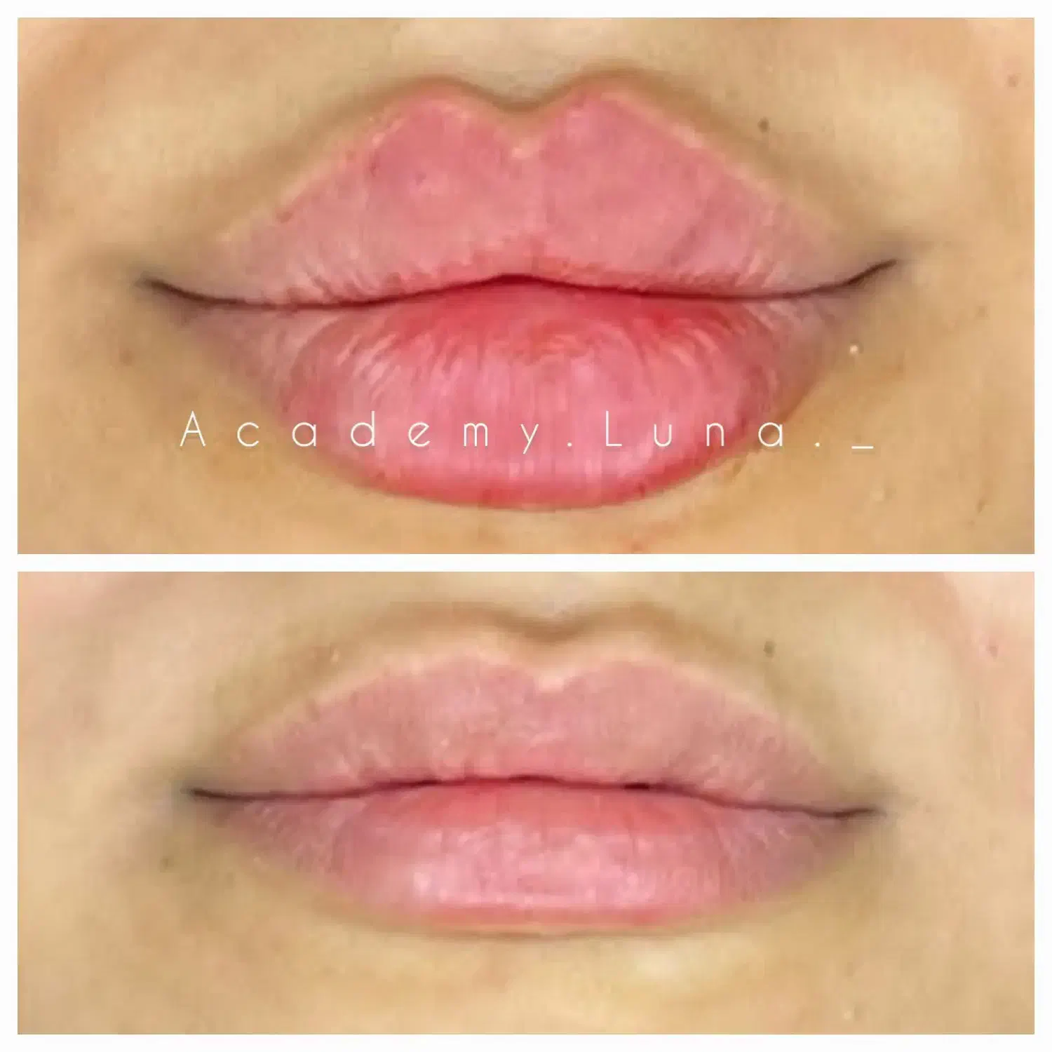 ژل بوتاکس|خدمات آرایشگری و زیبایی|قم, بکایی|دیوار