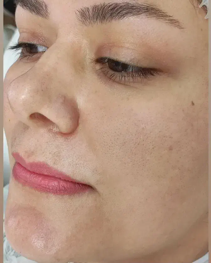 فیشیال صورت آقایان و خانم ها مطب دکترپروین گودرزی|خدمات آرایشگری و زیبایی|یاسوج, |دیوار