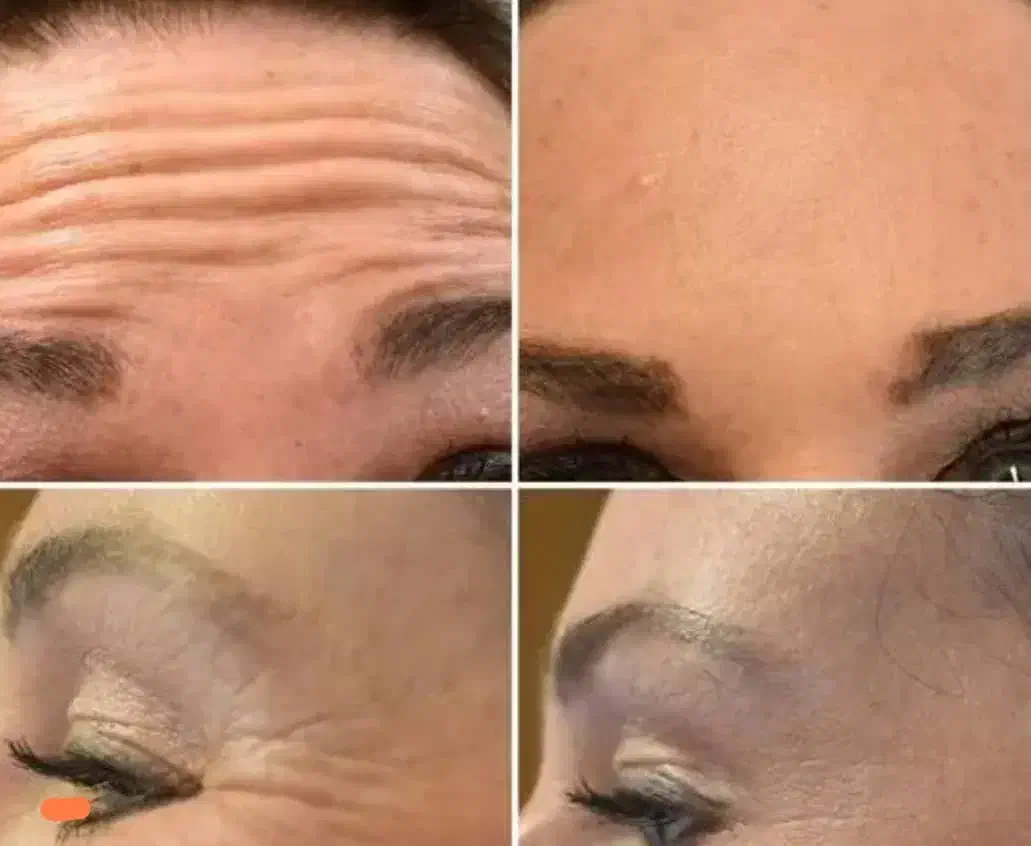 آموزش تزریق بوتاکس|خدمات آموزشی|فردیس, فرامرزیه|دیوار