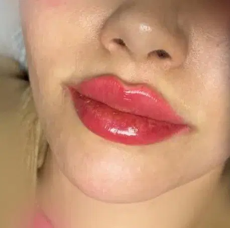 فیلرچانه ولب تزریق ژل لیزرمادلینگ پزشک|خدمات زیبایی و سلامت|تهران, صادقیه|دیوار