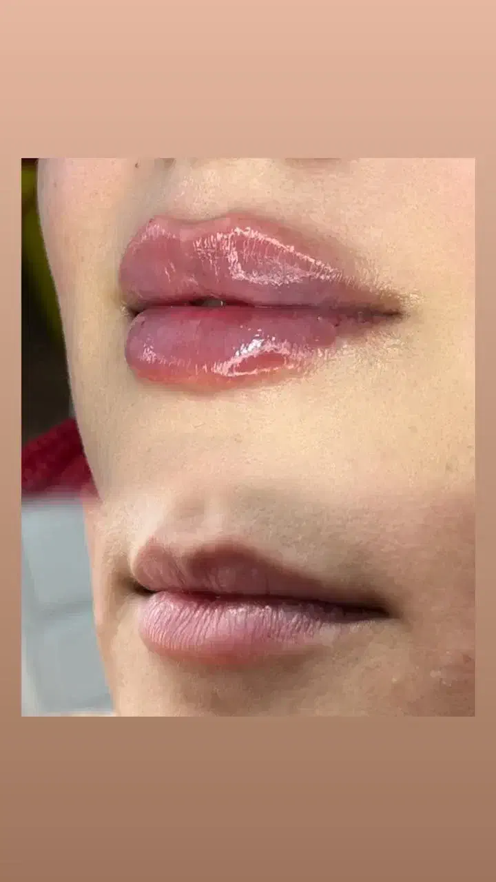 تزریق ژل لب،بوتاکس،مزو تراپی،هایفو تراپی،لیزر|خدمات آرایشگری و زیبایی|فردیس, شهرک ارم|دیوار