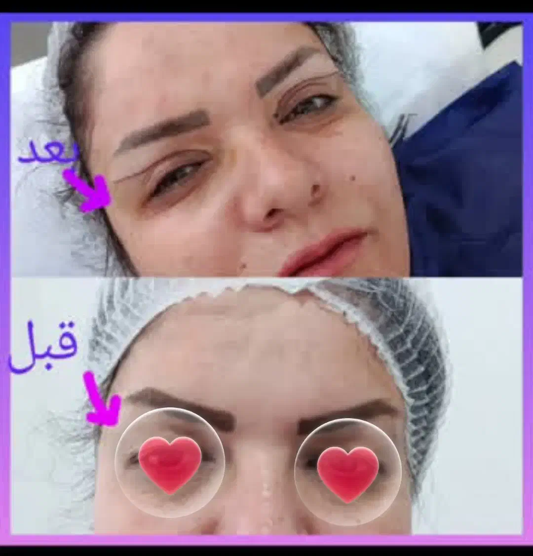 تخلیه وتزریق چربی لابیا جراحی پلک دایرکت اتوپلاستی|خدمات آرایشگری و زیبایی|دورود, |دیوار