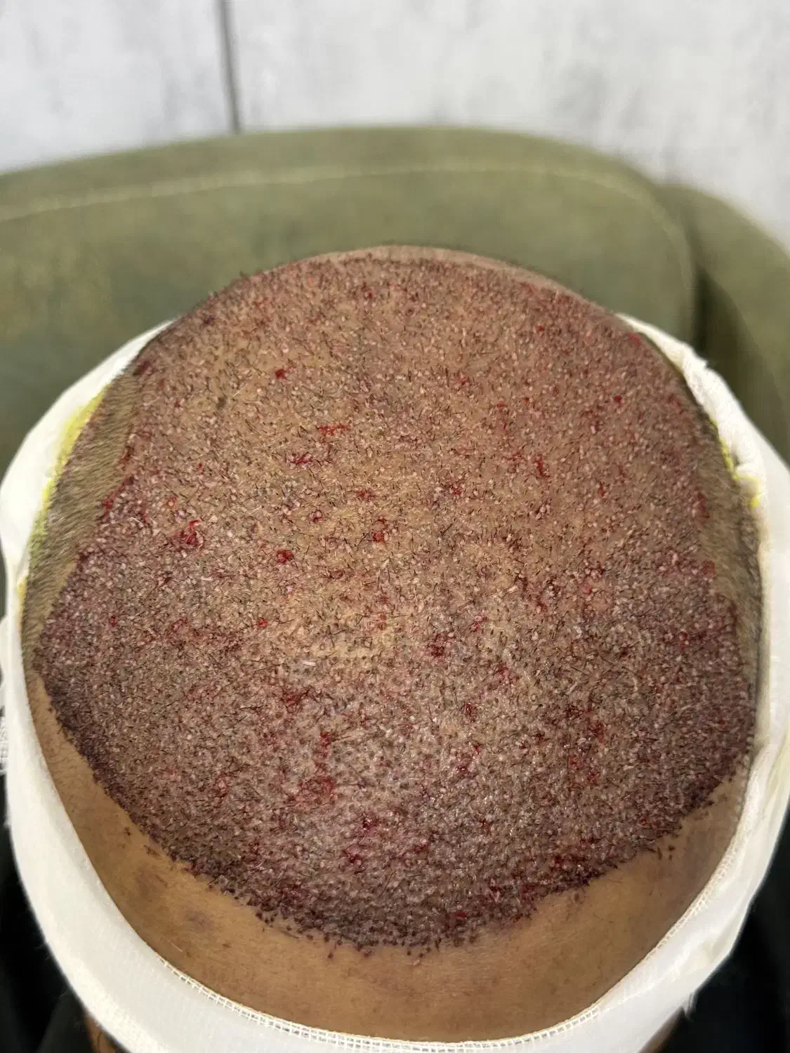 کاشت مو و ابرو|خدمات آرایشگری و زیبایی|کازرون, |دیوار