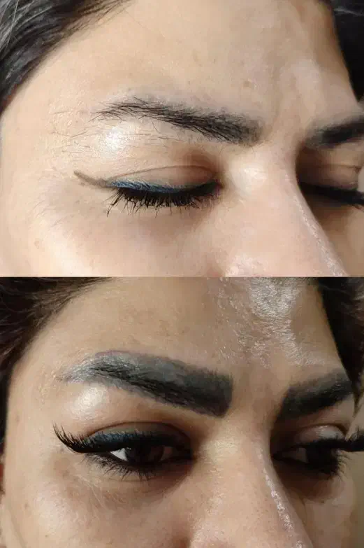 ریموو تتو های قدیمی بدن با دستگاه لیزر کیوسوییچ|خدمات آرایشگری و زیبایی|اردبیل, |دیوار