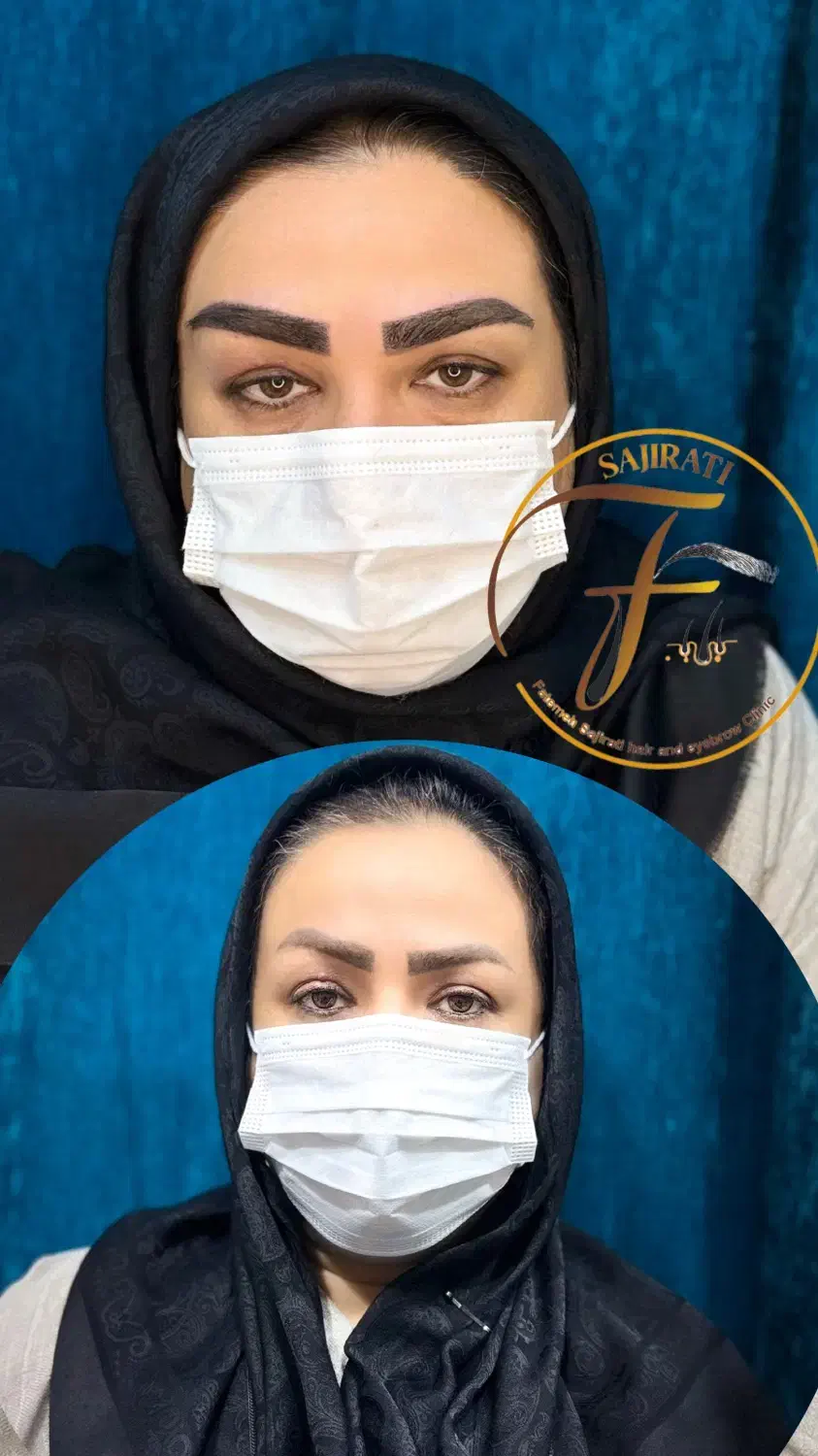 کاشت ابرو تخصصی در درمانگاه کمیل|خدمات آرایشگری و زیبایی|اهواز, زیتون کارمندی|دیوار