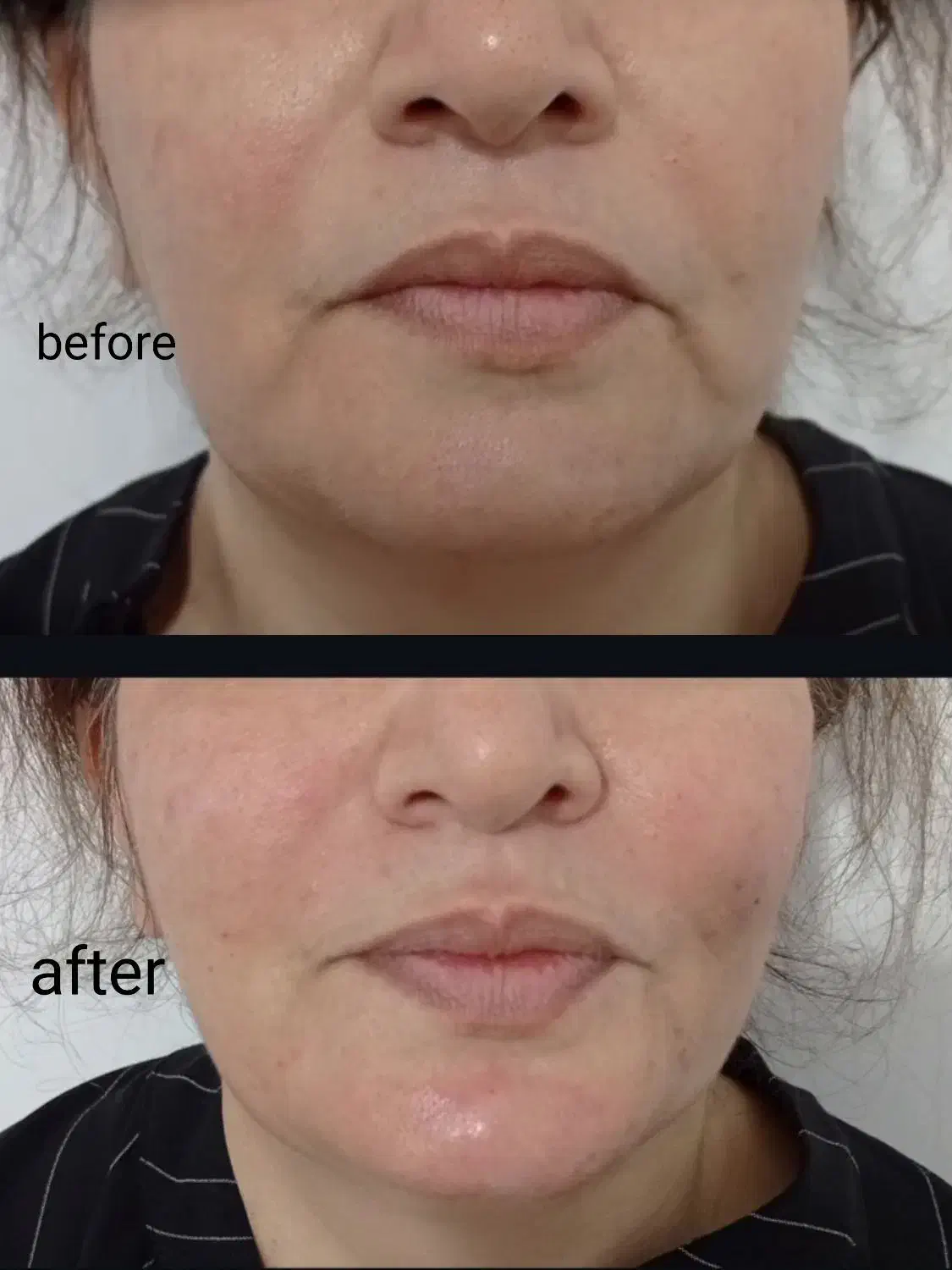 تخفیف بوتاکس و ژل|خدمات آرایشگری و زیبایی|دورود, |دیوار