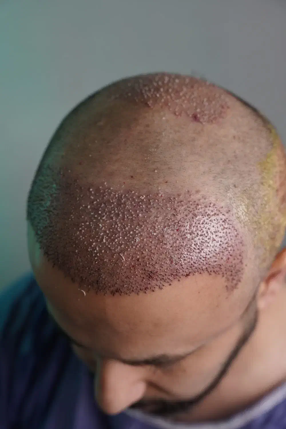 کاشت مو|خدمات آرایشگری و زیبایی|سقز, |دیوار