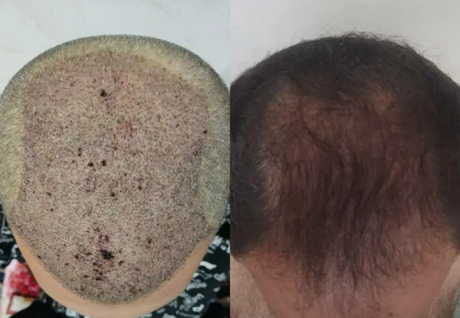 کاشت مو و ابرو|خدمات آرایشگری و زیبایی|تبریز, |دیوار