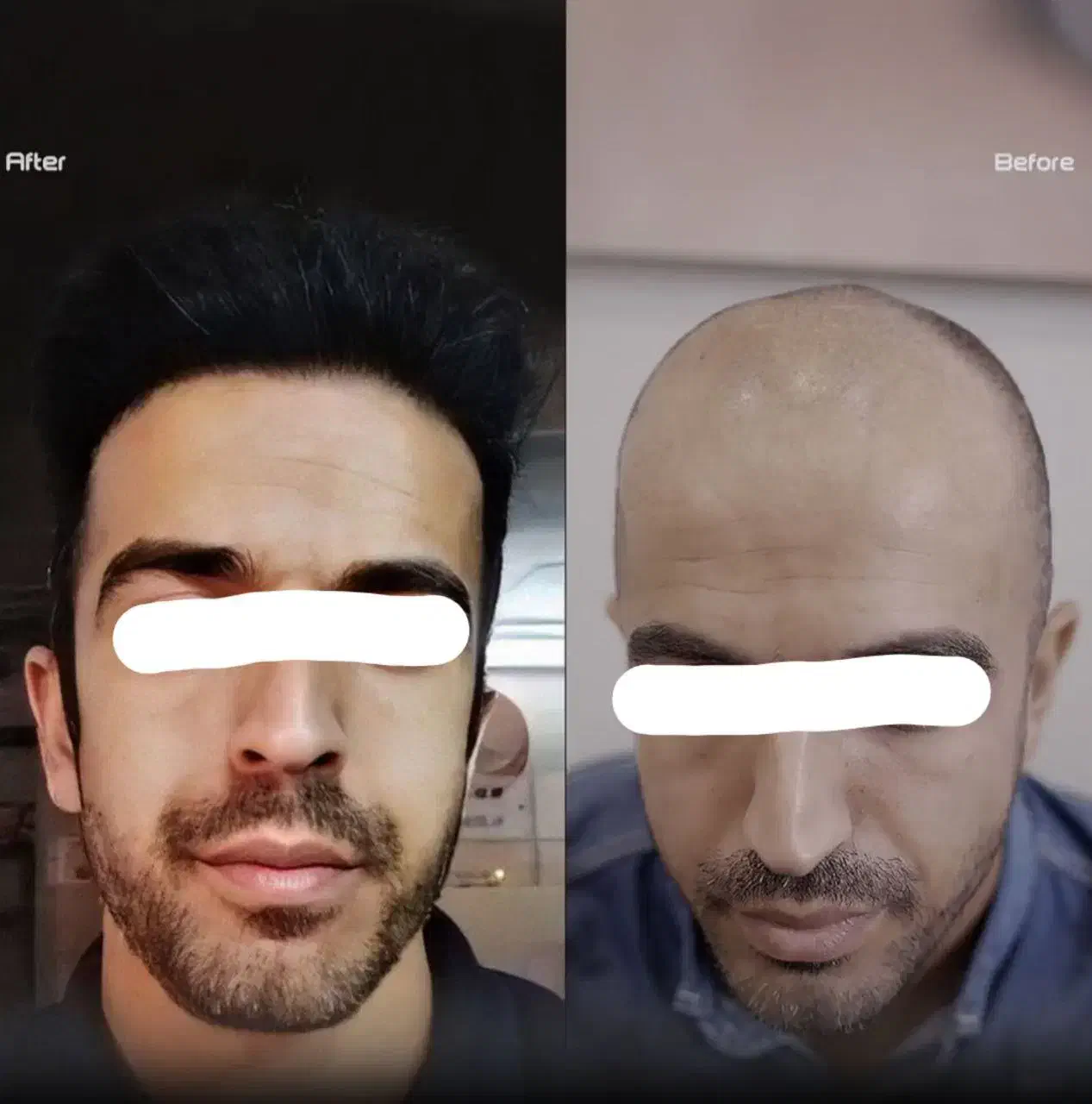 اقساطی/کاشت مو تضمینی/کاشت ابرو/ژل لب|خدمات آرایشگری و زیبایی|سنندج, |دیوار