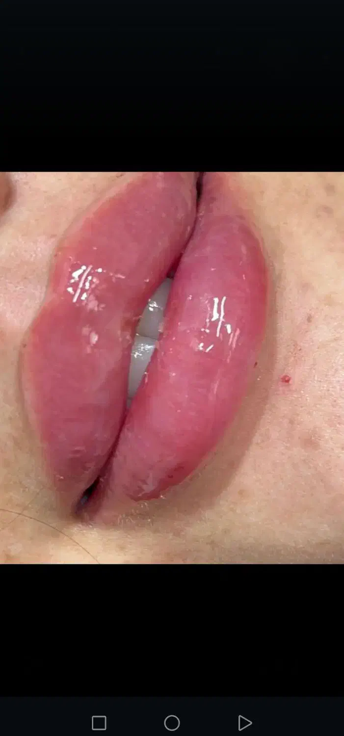 جشنواره تخفیف تزریق تخصصی ژل و بوتاکس|خدمات آرایشگری و زیبایی|شیراز, محراب|دیوار