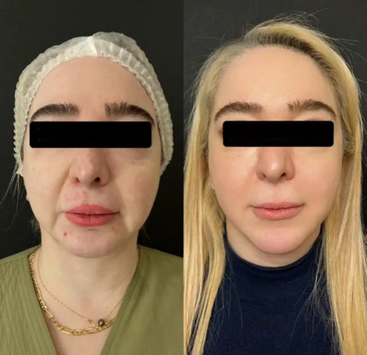 هایفو(لیفت صورت در یک جلسه)تخفیف ۵۰ درصدی|خدمات آرایشگری و زیبایی|مشهد, وکیل‌آباد|دیوار