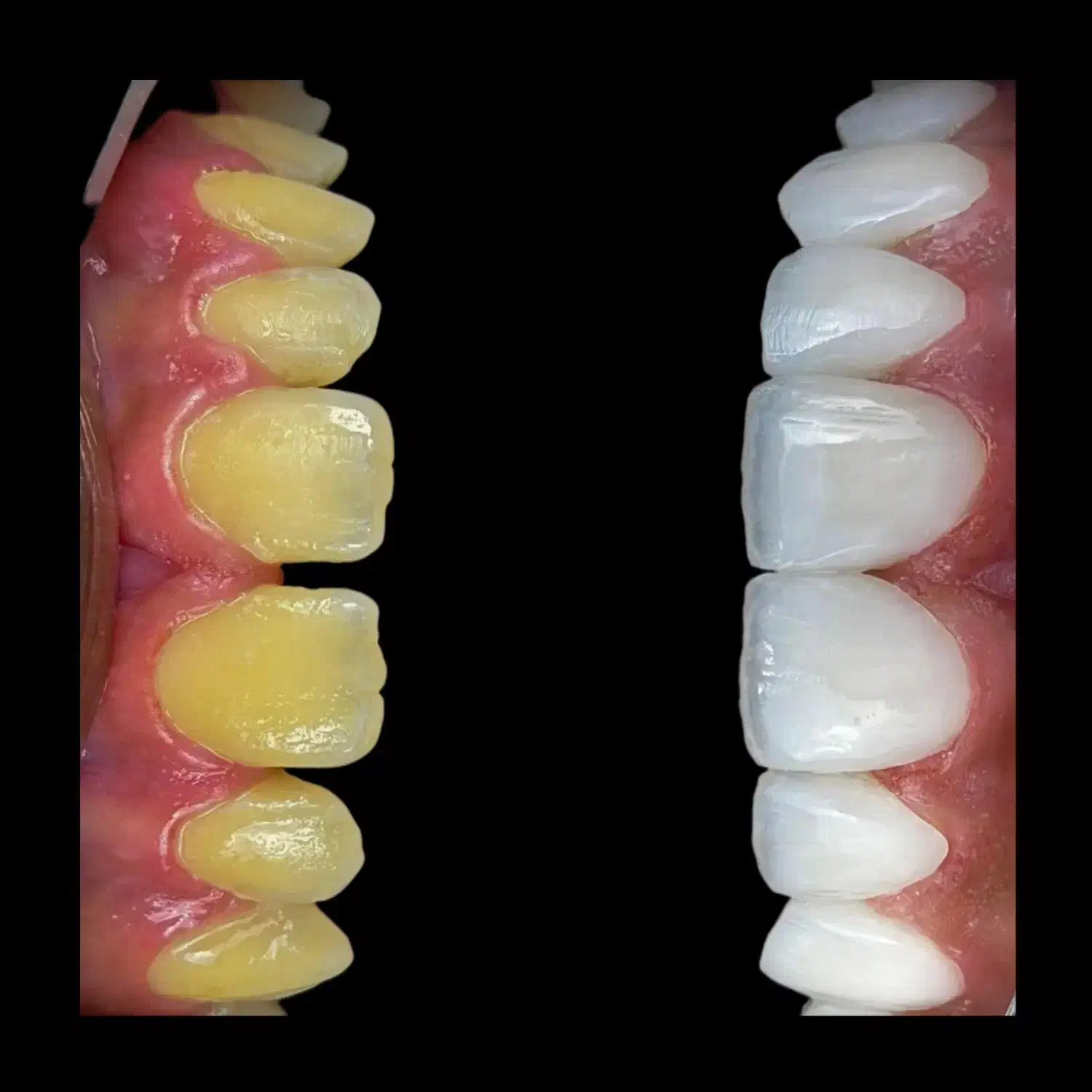 ۵۰ درصد تخفیف کامپوزیت لبه شفاف|خدمات آرایشگری و زیبایی|گرگان, |دیوار