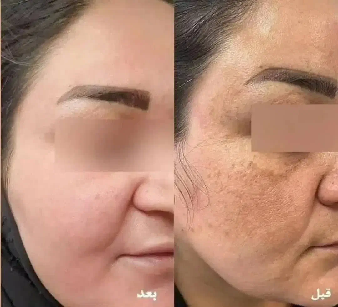 کرم سفیده کننده صددرصد تضمینی|آرایشی، بهداشتی، درمانی|رفسنجان, |دیوار