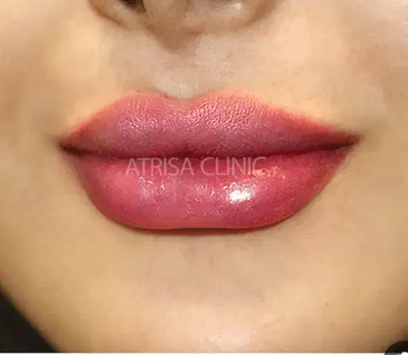 اپراتور تزریق ژل و اپراتور دستگاه لیزر|استخدام درمانی، زیبایی، بهداشتی|خرم‌آباد, |دیوار