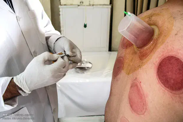 حجامت سنتی مراعات بهداشتی|خدمات آرایشگری و زیبایی|خاش, |دیوار