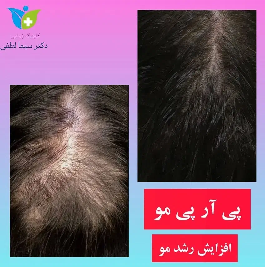 تزریق ژل بوتاکس جوانسازی پی آر پی کربوکسی و لاغری|خدمات آرایشگری و زیبایی|قزوین, |دیوار