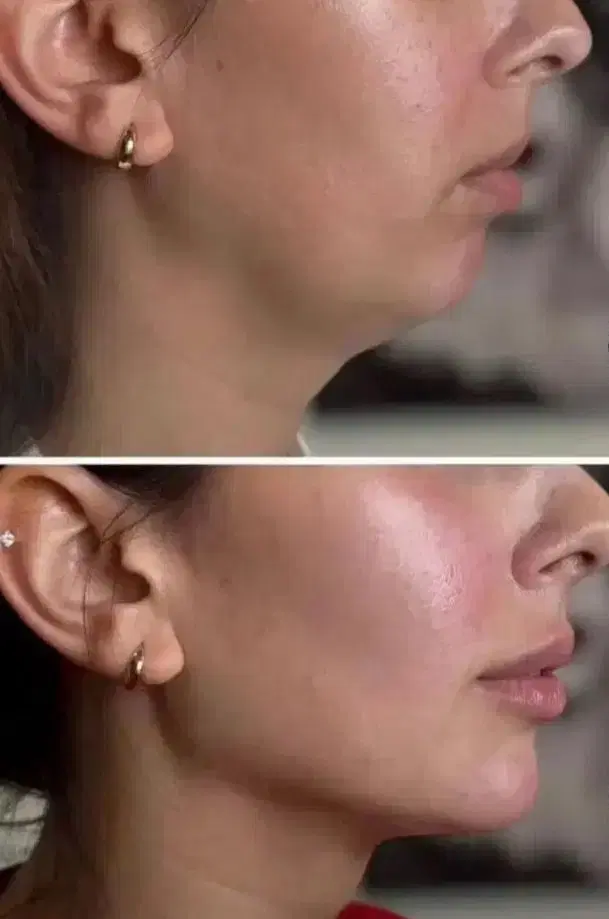 تزریق ژل فیلر بوتاکس مزو فیلر بادی قیمت استثنایی|خدمات زیبایی و سلامت|شیراز, فضل‌آباد|دیوار