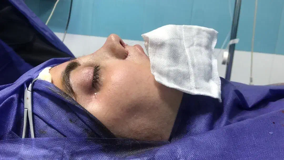 جراحی بینی باتخفیف ویژه جشنواره|خدمات آرایشگری و زیبایی|ساری, |دیوار