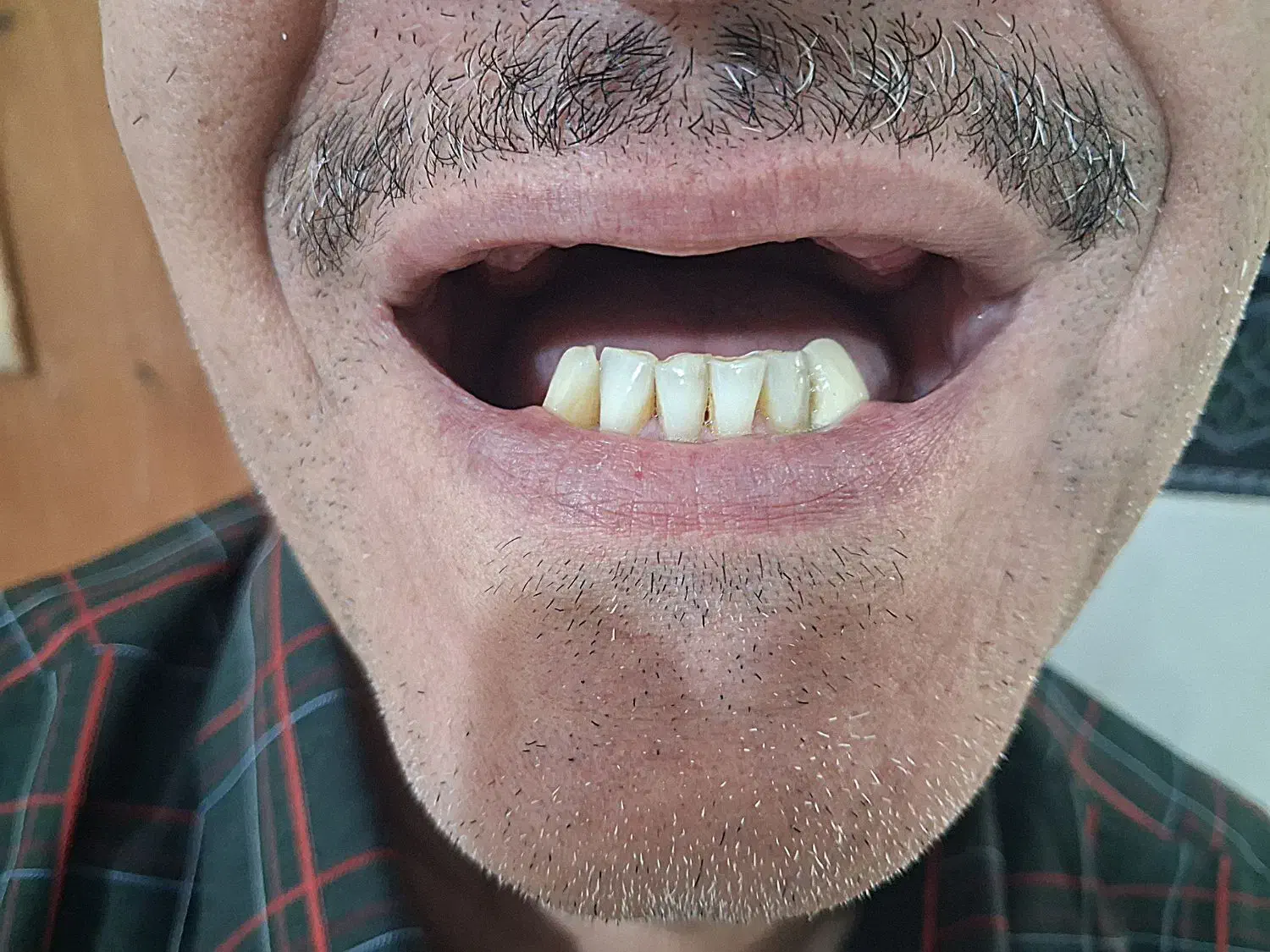 پروتز دندان|خدمات آرایشگری و زیبایی|ابهر, |دیوار