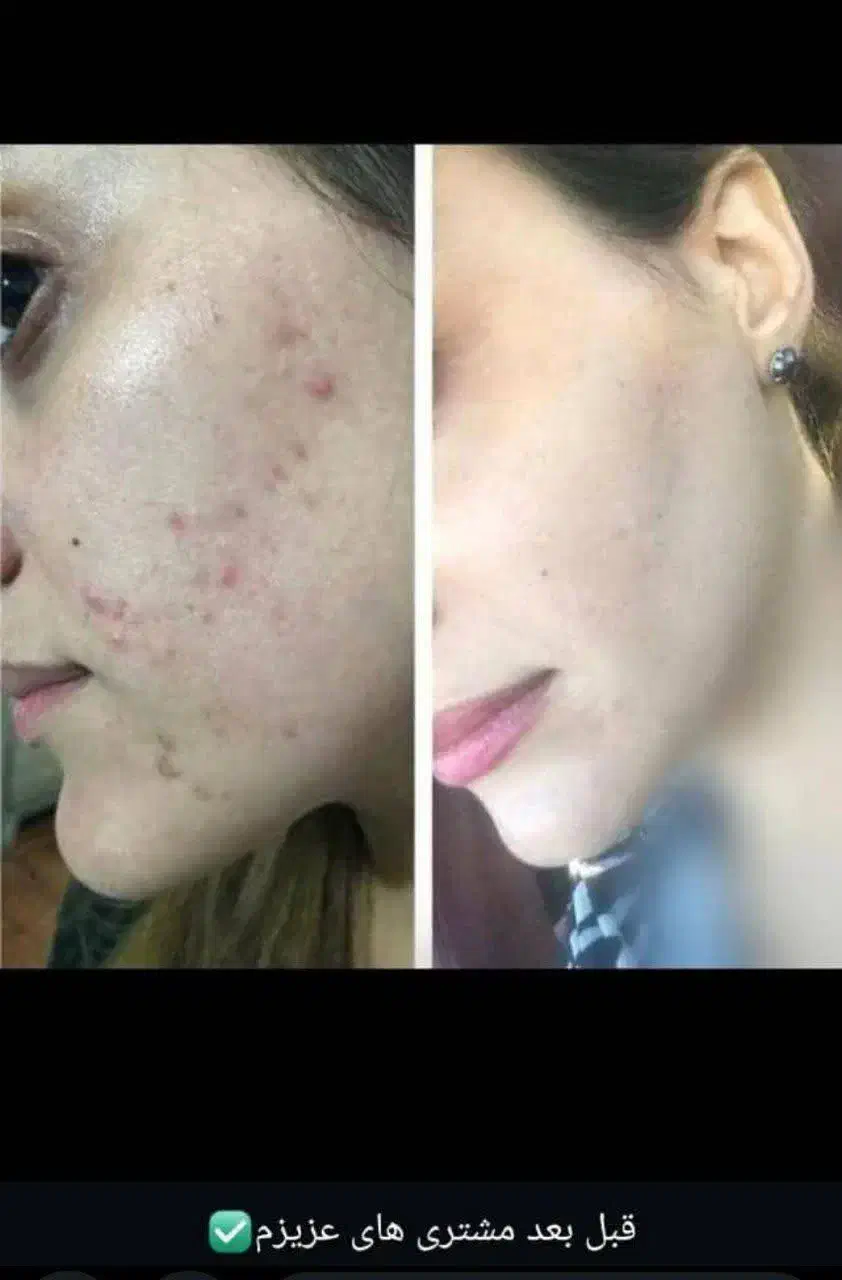 نمایندگی کرم رویال پنج تادهدرجه روشن کنندضدلک قوی|آرایشی، بهداشتی، درمانی|یاسوج, |دیوار