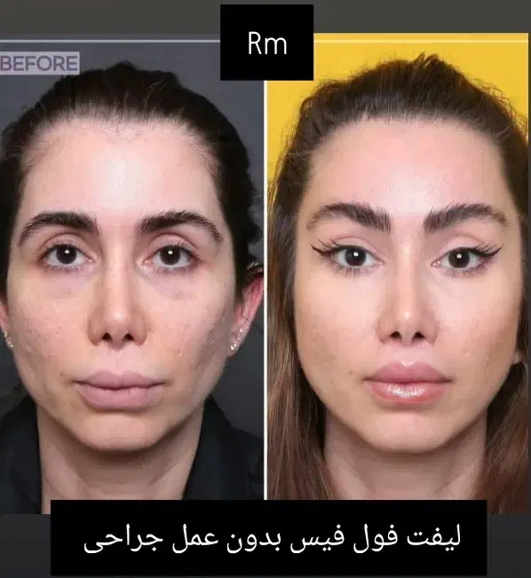 لیفت فول فیس صورت لیفت چشم گربه ای بدون عمل جراحی|خدمات آرایشگری و زیبایی|ری, دیلمان|دیوار