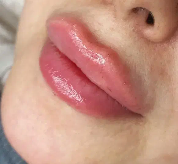 جشنواره ی تزریق بوتاکس و ژل و جوانسازها (هایفو،RF)|خدمات آرایشگری و زیبایی|تهران, نیلوفر|دیوار