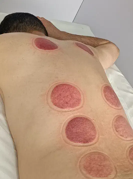 آموزش دوره تخصصی حجامت فصد زالو بادکش|خدمات آموزشی|کرج, کمال‌شهر|دیوار