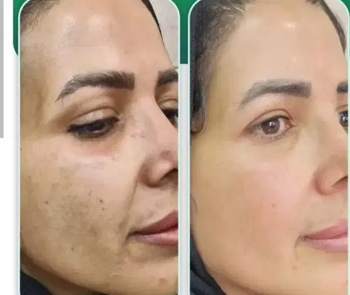 لیزر(خانم ها)۳۰۰لیزر(آقایان )۶۰۰کربن تراپی رایگان|خدمات آرایشگری و زیبایی|نجف‌آباد, باغ ملی|دیوار