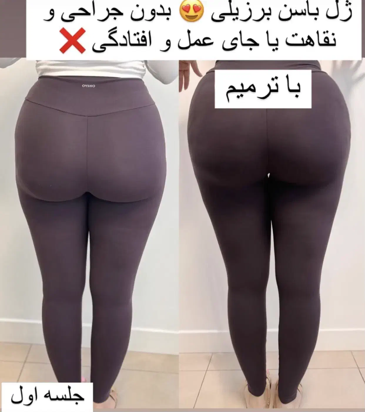 تزریق تخصصی فیلر بادی باسن سینه هیپ دیپ|خدمات آرایشگری و زیبایی|تهران, صادقیه|دیوار