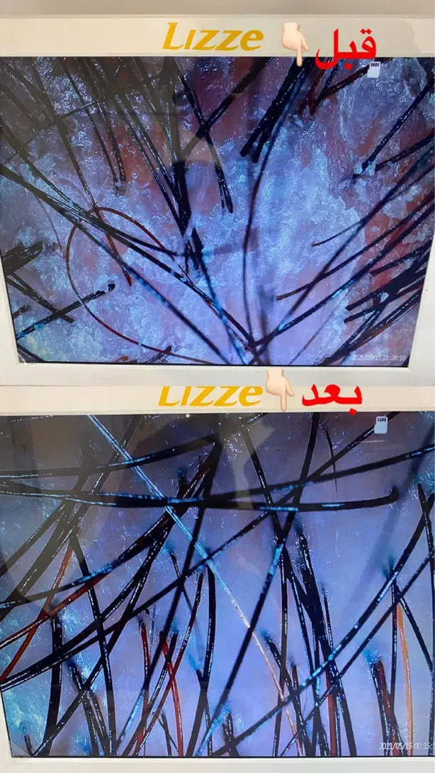 درمان مشکلات مو و پوست سر(اسکراب اسکالپ)|خدمات آرایشگری و زیبایی|شیراز, تاچارا|دیوار