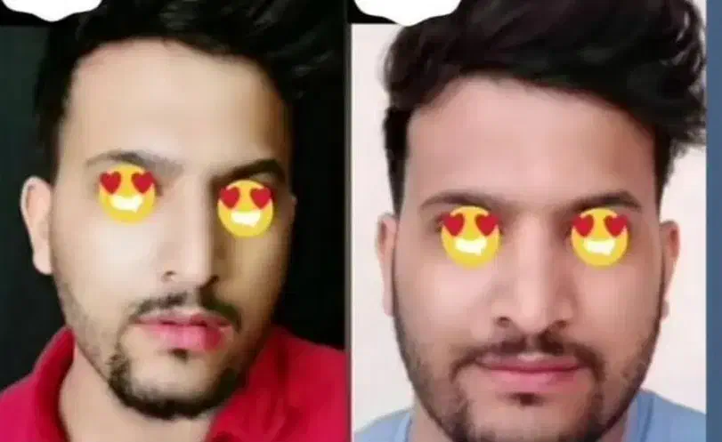 پرکننده صورت فرانسوی ۱۵روزه بدون کورتون و عوارض|آرایشی، بهداشتی، درمانی|اهواز, باغ شیخ|دیوار
