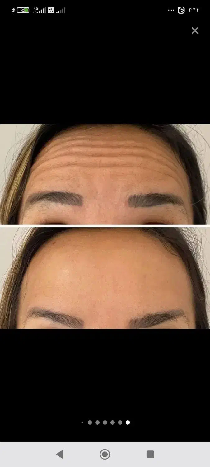 تزریق بوتاکس وژل فقط قیمت مواد|خدمات آرایشگری و زیبایی|اهواز, ۲۴ متری|دیوار