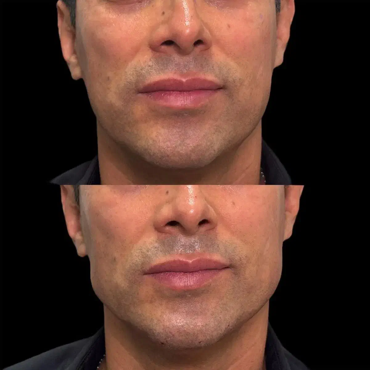 جشنواره  تزریق ژل  لب روسی وبوتاکس انزیم فیلر|خدمات آرایشگری و زیبایی|کرج, گلشهر|دیوار