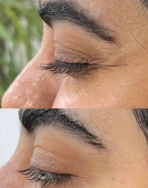 بوتاکس|خدمات آرایشگری و زیبایی|اهواز, پردیس|دیوار