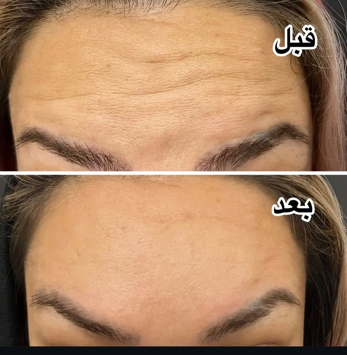 بوتاکس|خدمات آرایشگری و زیبایی|ایذه, |دیوار