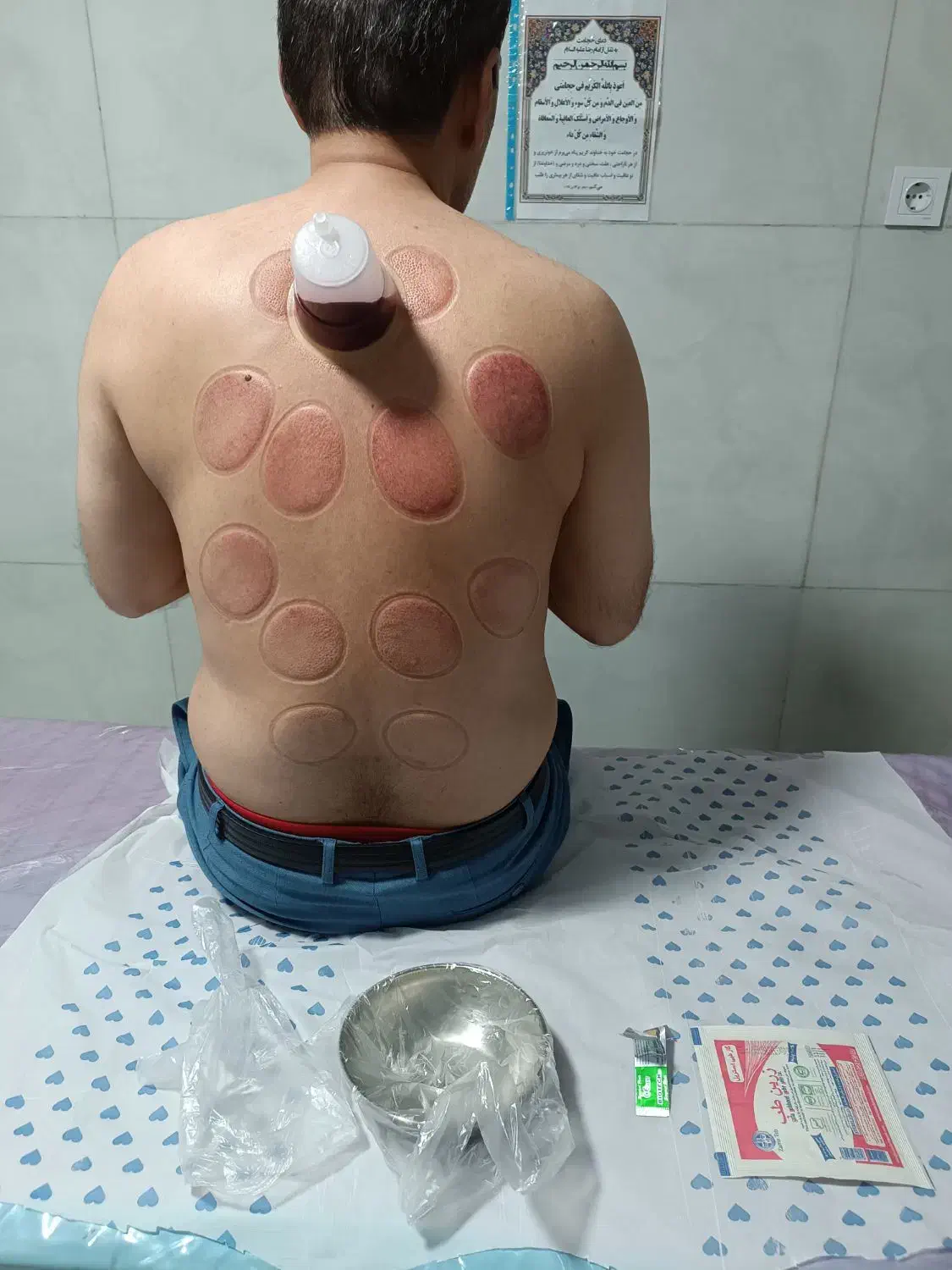 حجامت و بادکش درمانی (تحت نظر پزشک)|خدمات آرایشگری و زیبایی|خرم‌آباد, |دیوار