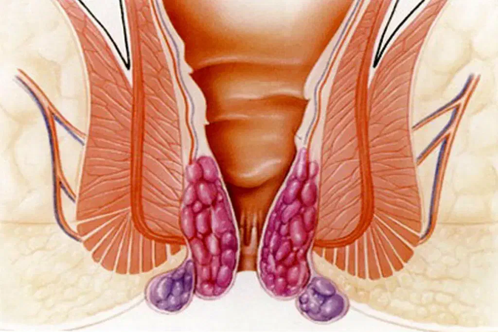 درمان بواسیر وشقاق وهموریید|خدمات آرایشگری و زیبایی|گنبد کاووس, |دیوار