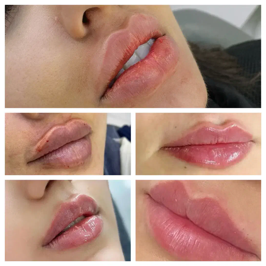 آموزش تخصصی فیلر بوتاکس لیفت با نخ توسط پزشک|خدمات آموزشی|بجنورد, |دیوار