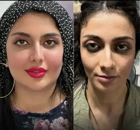 تزریق تخصصی ژل وبوتاکس،چربی،هایفو،نخ،توسط پزشک|خدمات آرایشگری و زیبایی|کرمانشاه, |دیوار