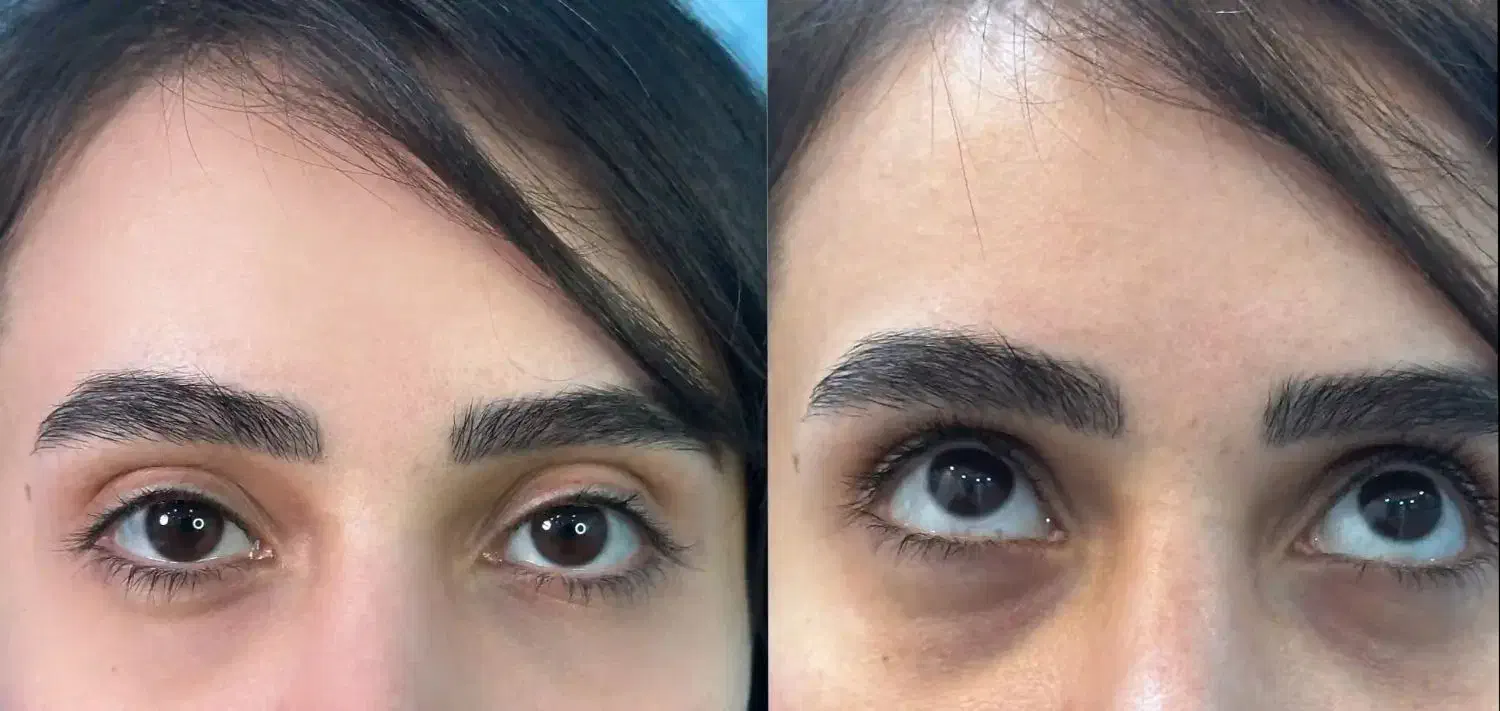 تخفیف ویژه تزریق فیلر|خدمات آرایشگری و زیبایی|اندیشه, اندیشه فاز ۱|دیوار