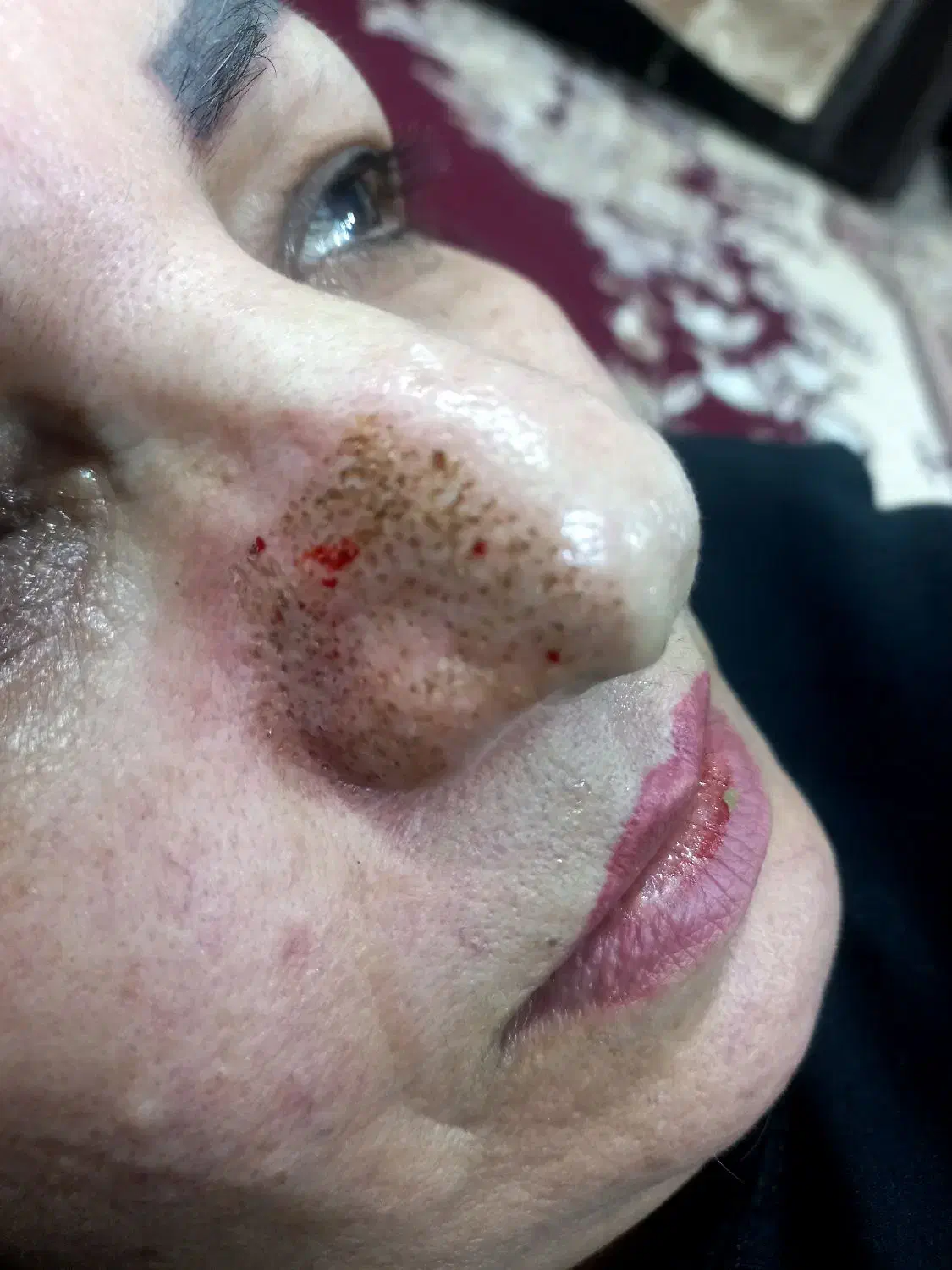 برداشتن خال و زگیل|خدمات آرایشگری و زیبایی|گرگان, |دیوار