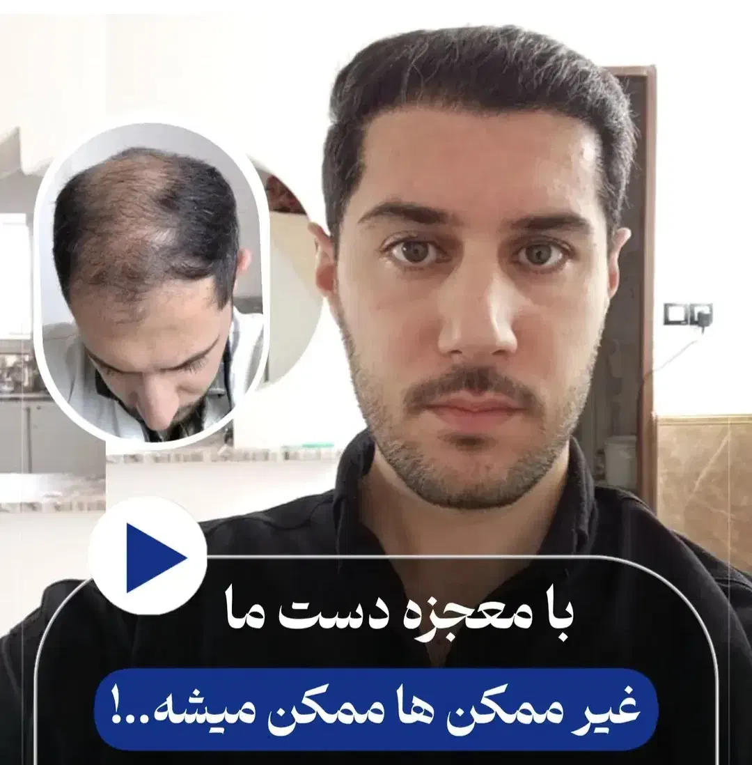 کاشت مو طبیعی شیراز|خدمات آرایشگری و زیبایی|شیراز, قصرالدشت|دیوار